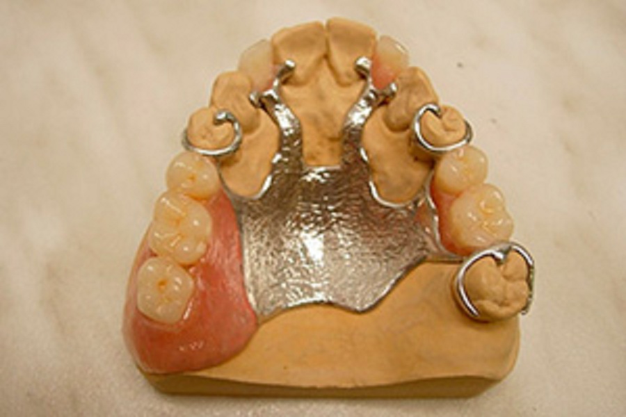 Бюгельный протез дефекты. Шинирующий бюгель на верхней челюсти. Бюгельный протез на 1 зуб верхней челюсти. Шинирующий бюгельный протез на верхнюю. Бюгельный протез на верхнюю челюсть на кламмерах.
